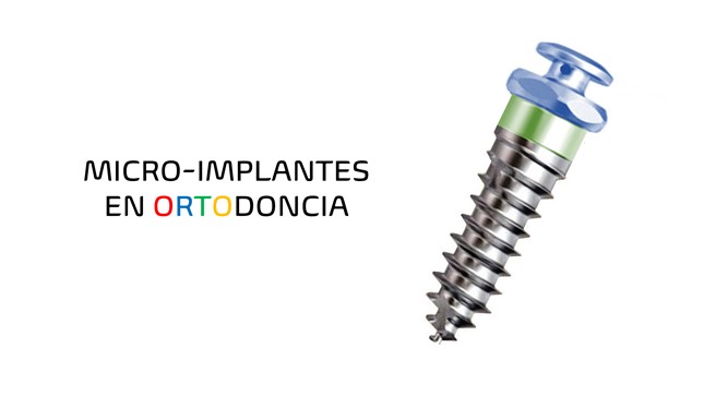 Microimplante de anclaje ortodóncico colocado en la zona interradicular del maxilar