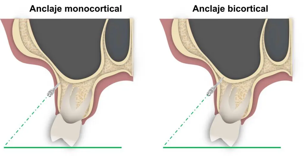 Micro-implantes monocortical y bicortical