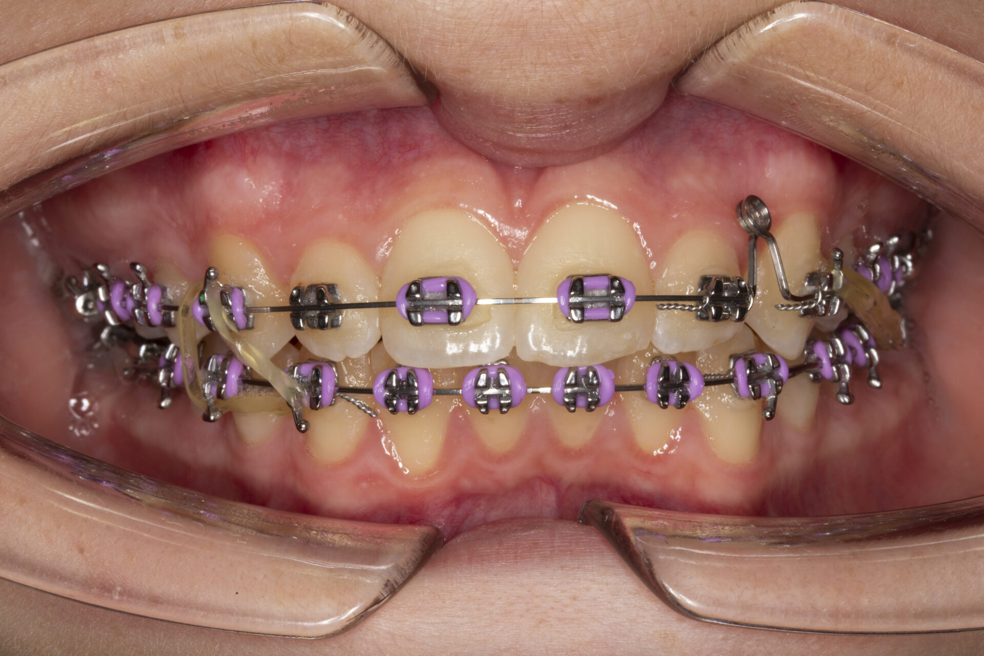 Figura 32 Foto Intraoral Frontal