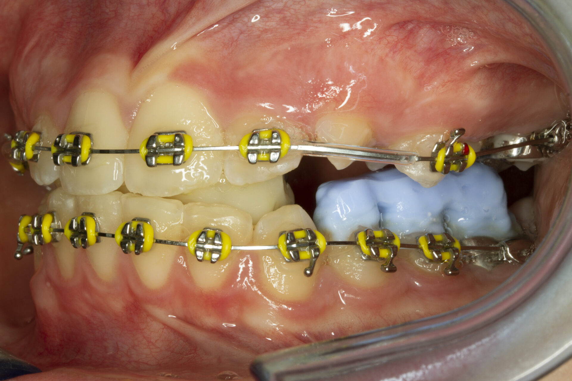 Figura 17 Foto Intraoral Izquierda