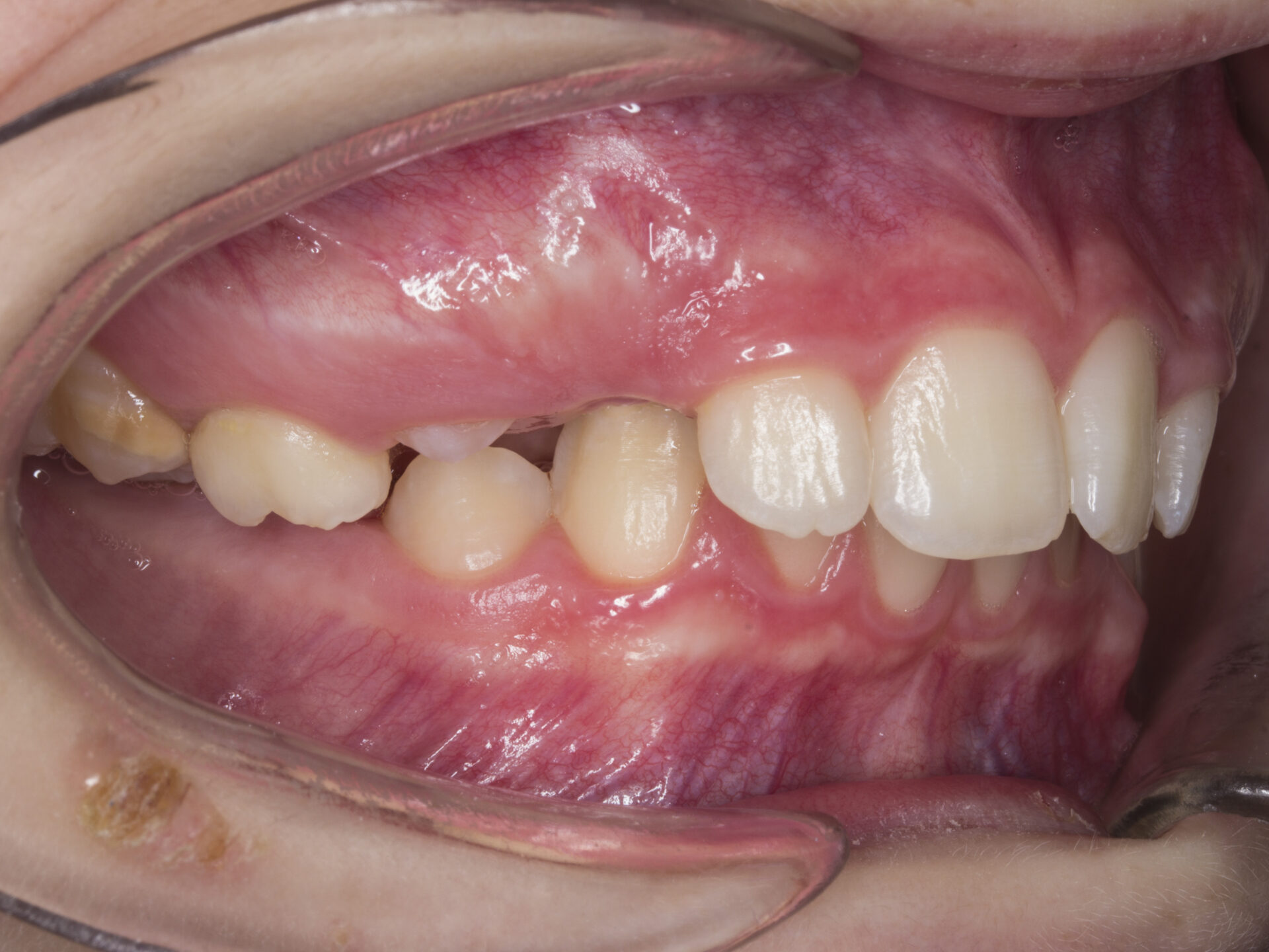 Figura 4 Foto Intraoral Derecha