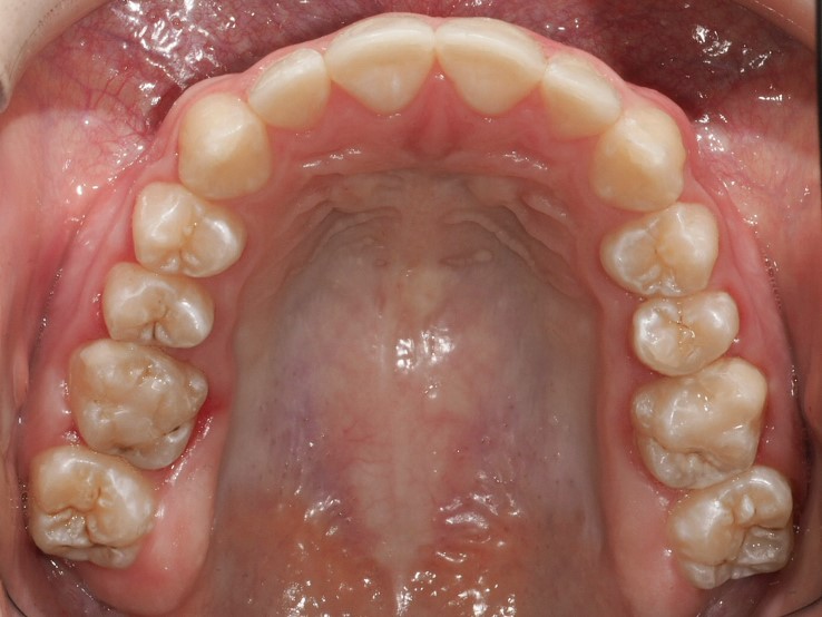 Figura 37 Foto Intraoral Oclusal Maxilar