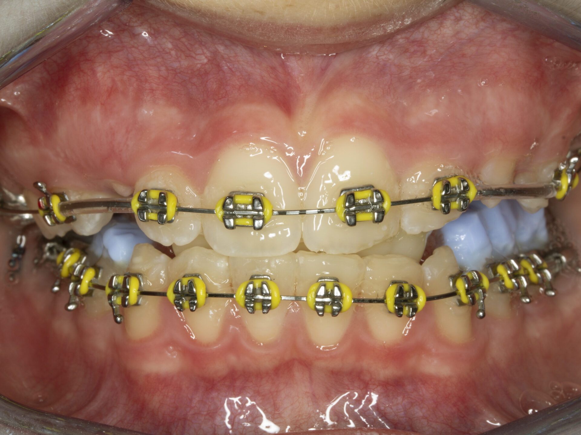 Figura 16 Foto Intraoral Frontal