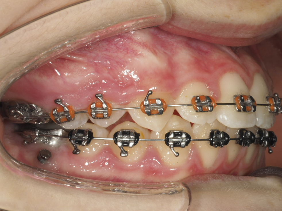 Figura 26 Foto Intraoral Frontal