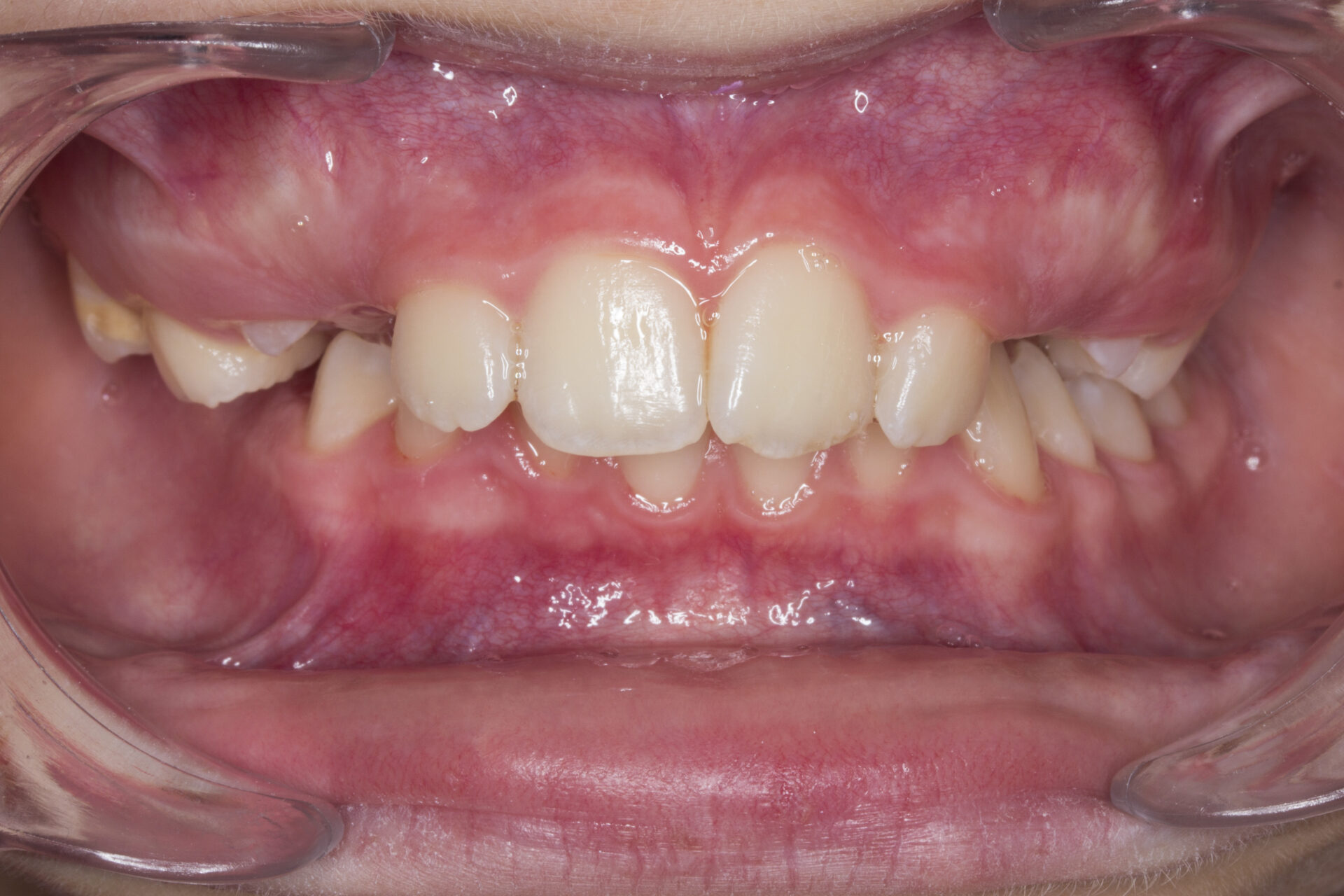 Figura 5 Foto Intraoral Frontal