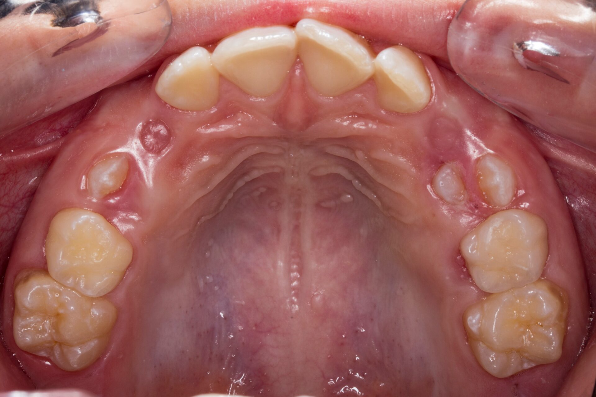 Figura 7 Foto Intraoral Oclusal Maxilar