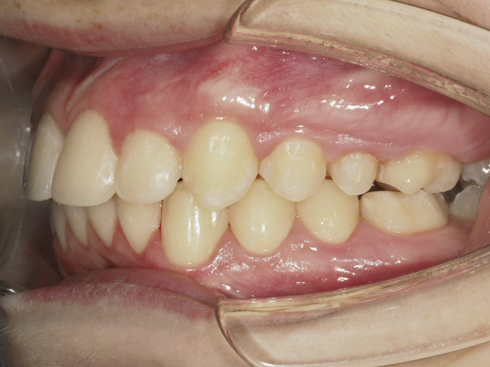 Figura 36 Foto Intraoral Izquierda