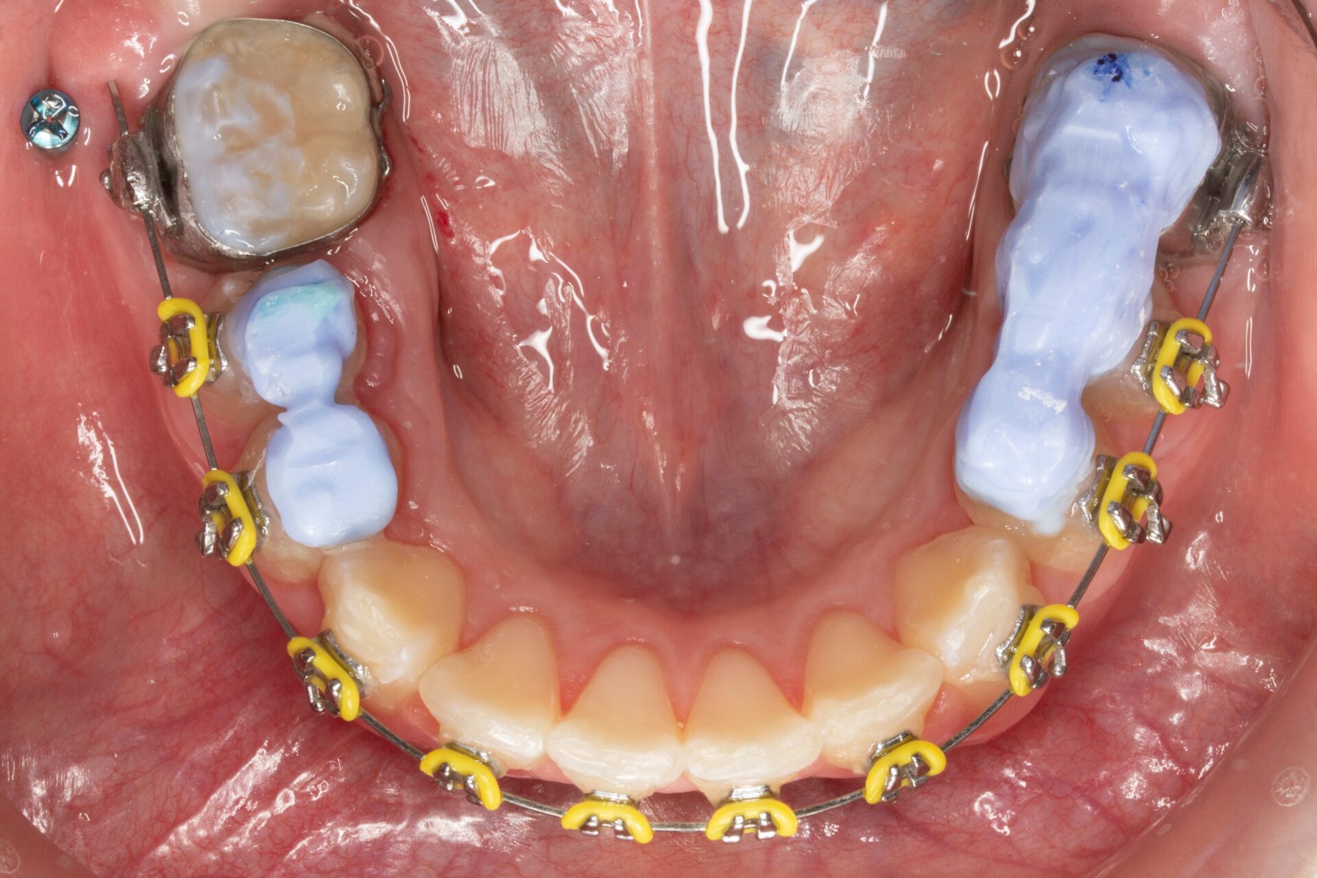 Figura 20 Foto Oclusal Mandibular