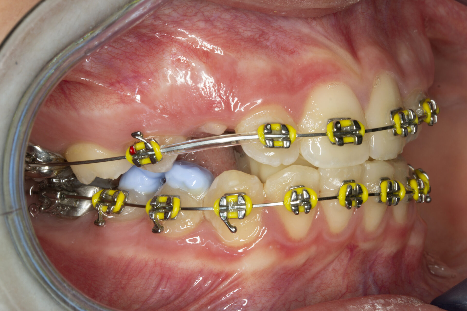 Figura 15 Foto Intraoral Derecha
