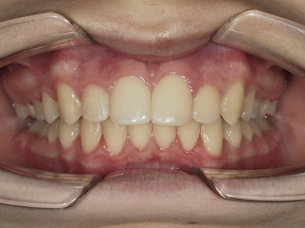 Figura 35 Foto Intraoral Frontal
