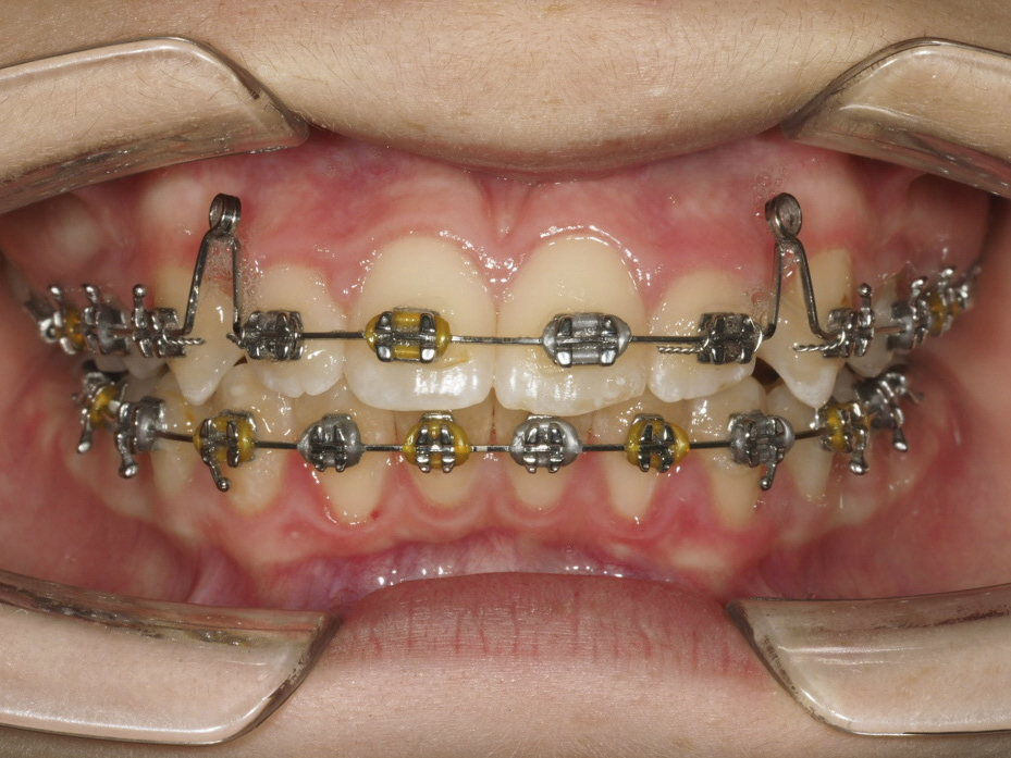 Figura 29 Foto Intraoral Frontal