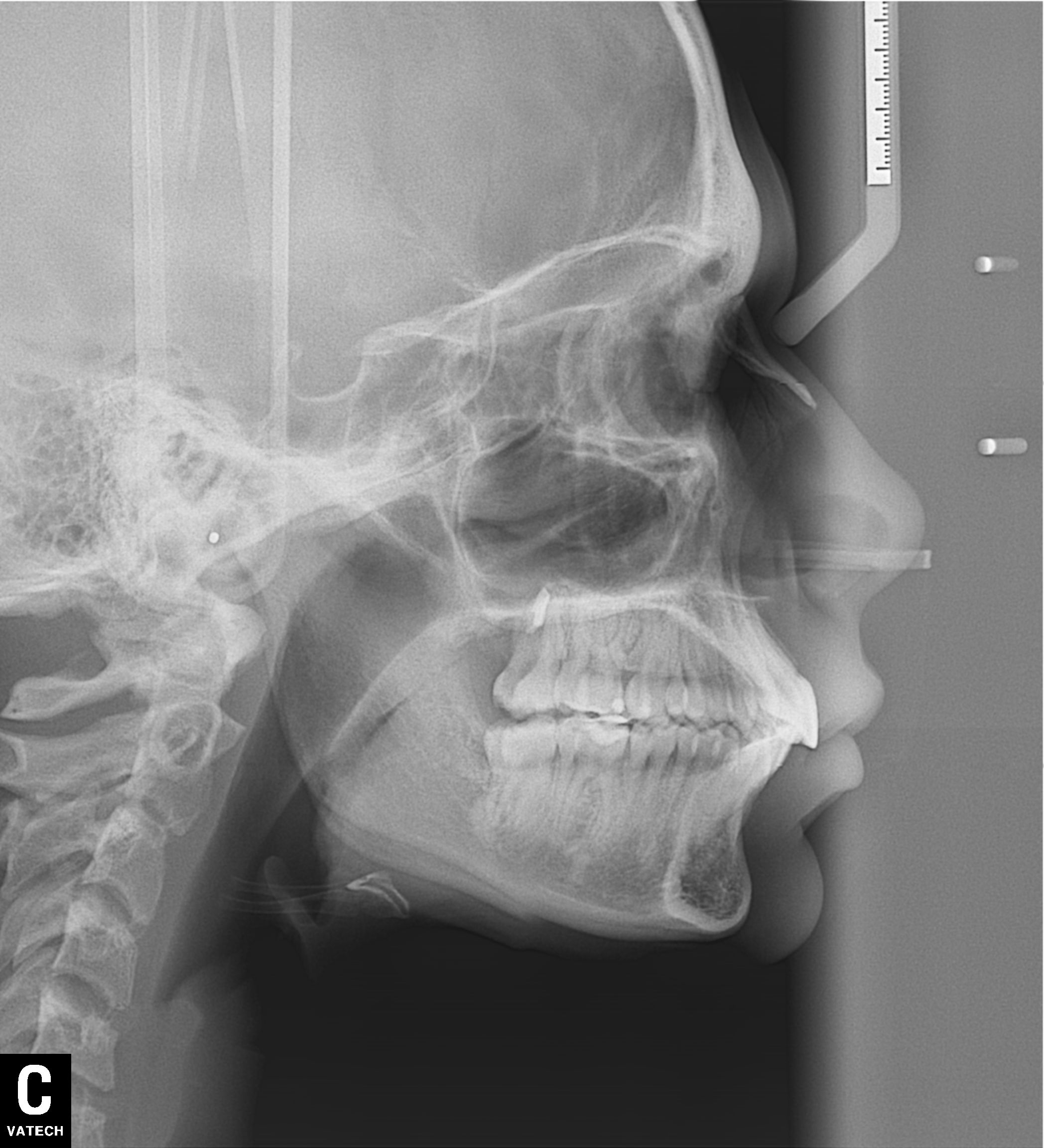 Figura 42 Telerradiografía