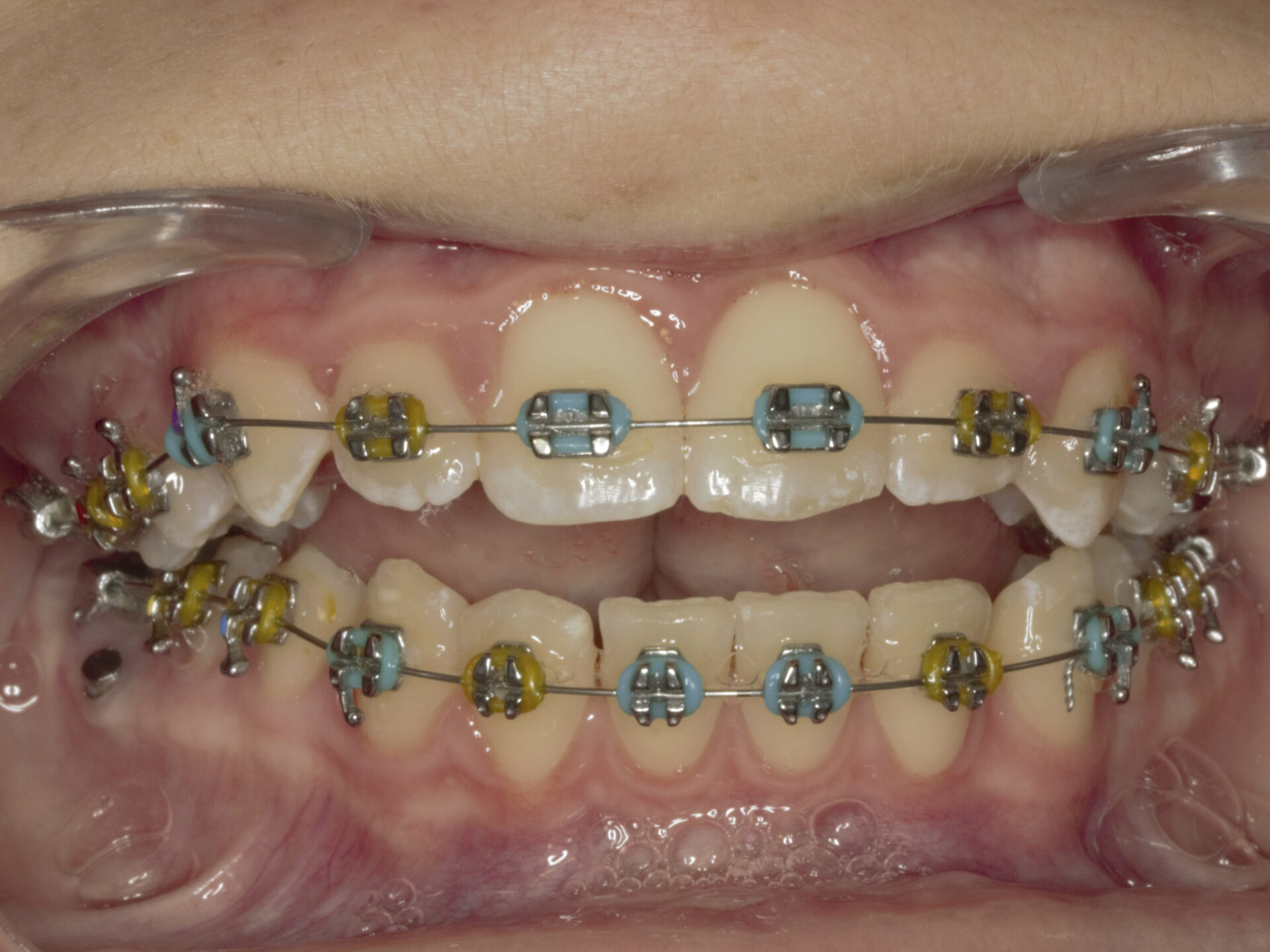 Figura 22 Foto Intraoral Frontal