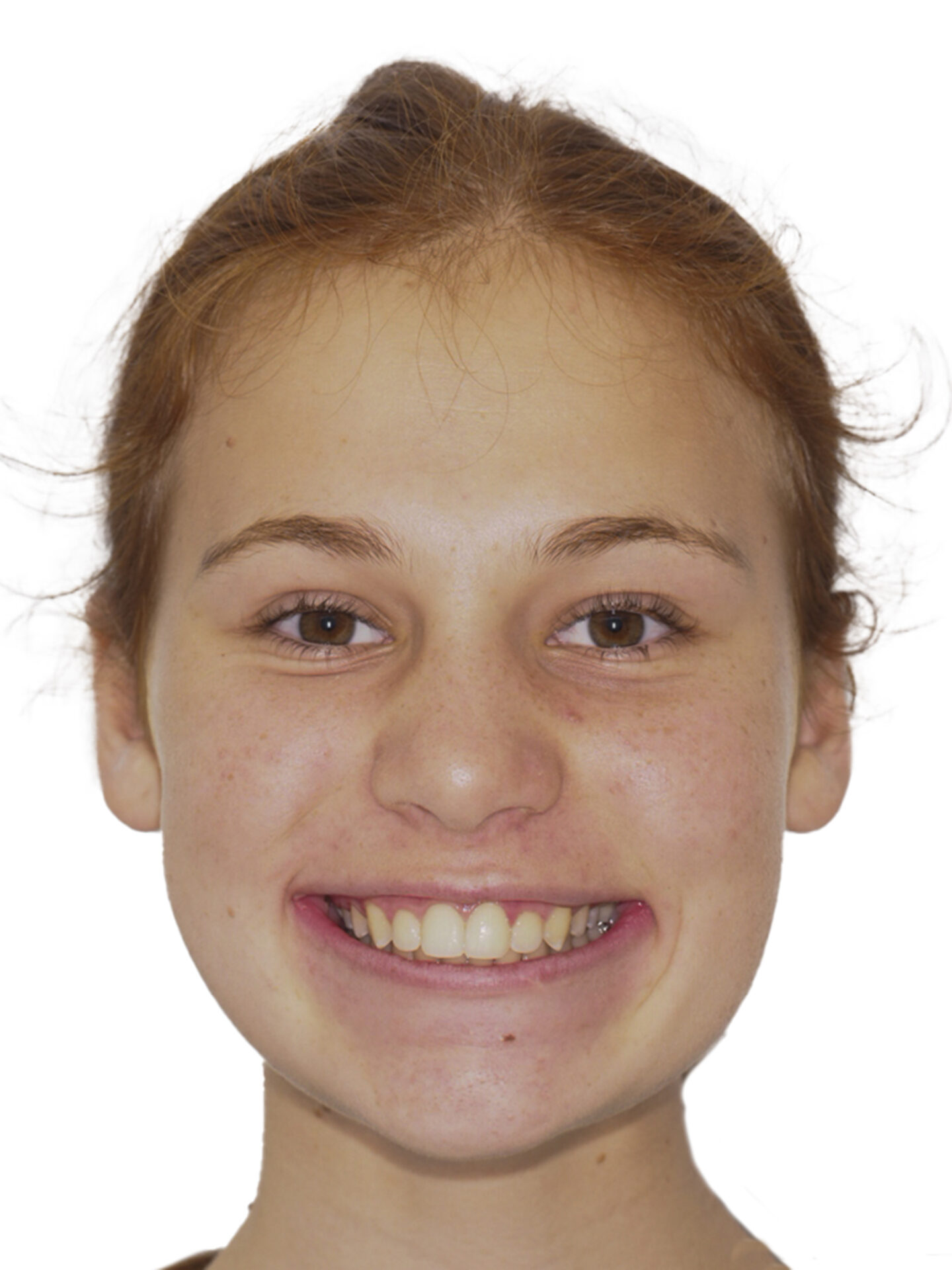 Figura 40 Foto Frontal Sonrisa