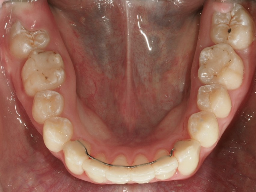 Figura 38 Foto Intraoral Oclusal Maxilar