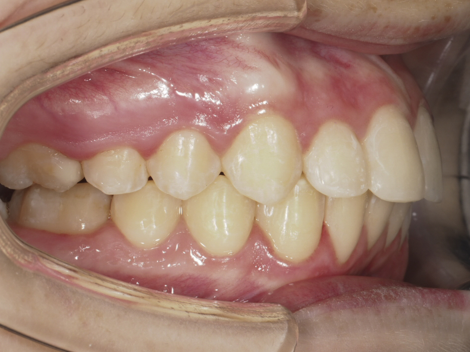 Figura 34 Foto Intraoral Derecha
