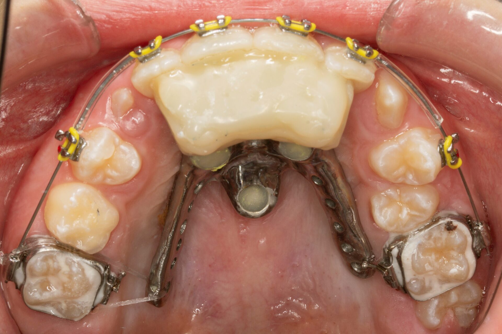 Figura 19 Foto Oclusal Maxilar