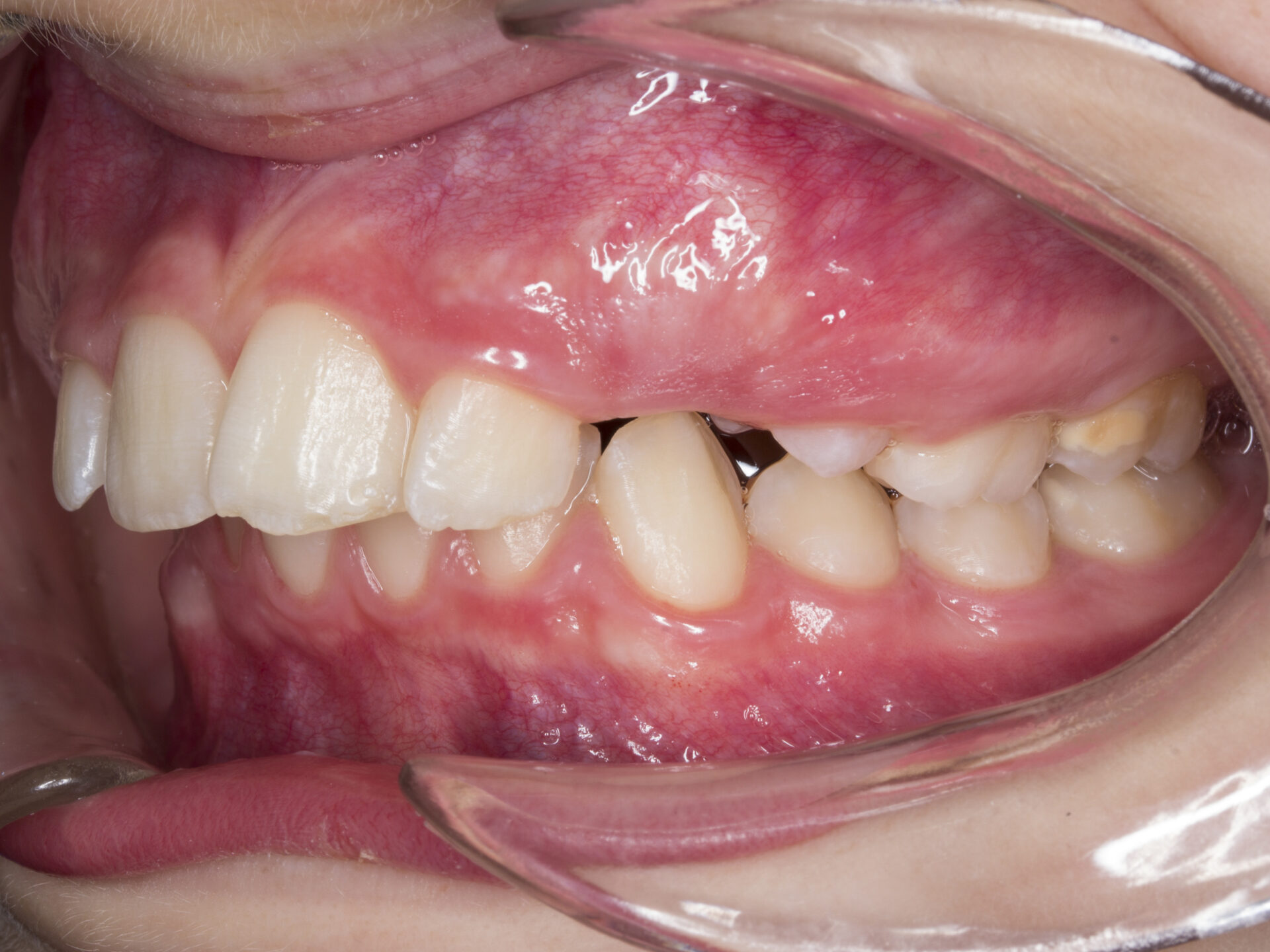Figura 6 FotoIntraoral Izquierda