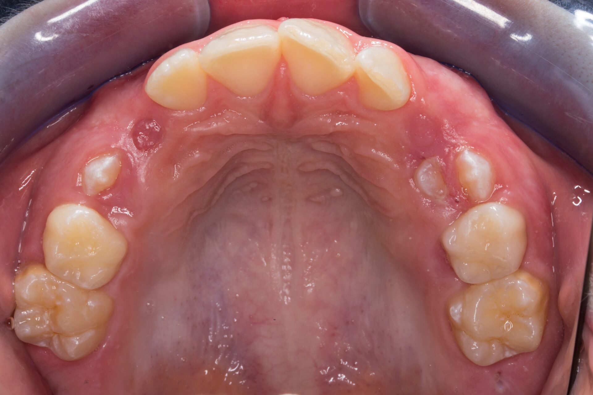 Figura 8 Foto Intraoral Oclusal Maxilar