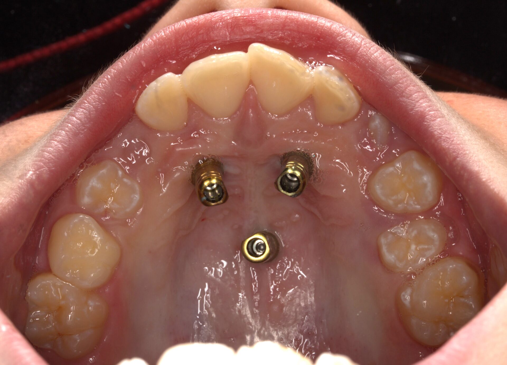 Figura 18 Foto detalle Implantes